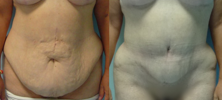 abdominoplastie-1-avant-apres Abdominoplastie avant après 1
