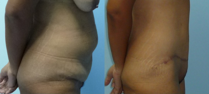 Abdominoplastie avant après 11