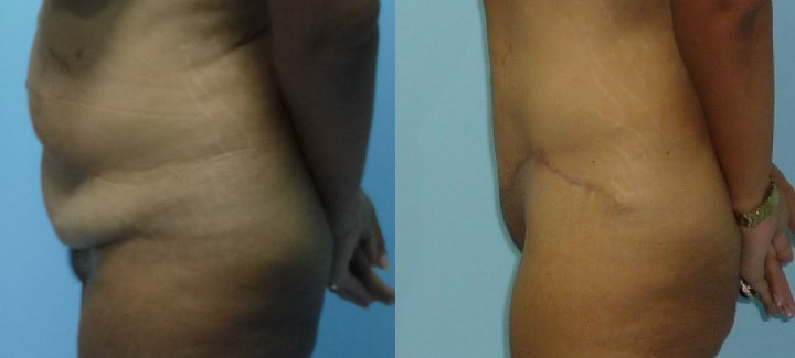 Abdominoplastie avant après 12
