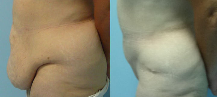 Abdominoplastie avant après 2