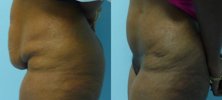 Abdominoplastie avant après 6