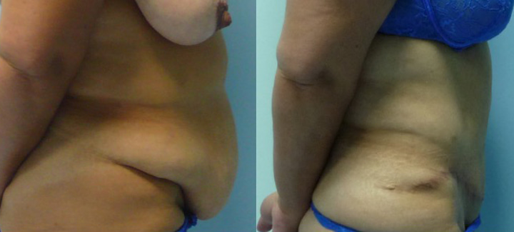 Abdominoplastie avant après 7