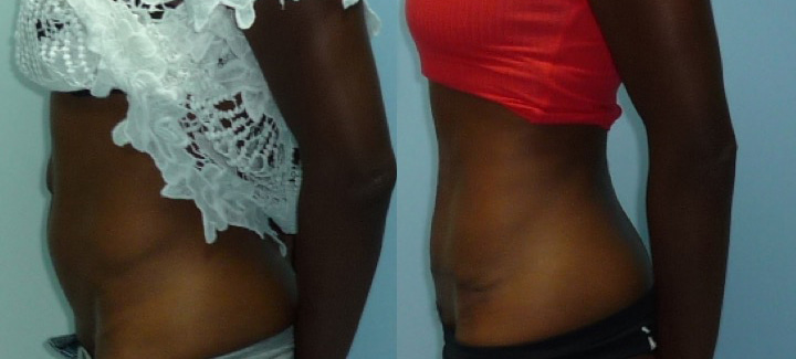 Abdominoplastie avant après 8