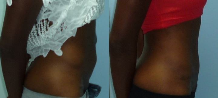 Abdominoplastie avant après 9