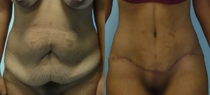 Chirurgie esthétique du ventre photo avant après