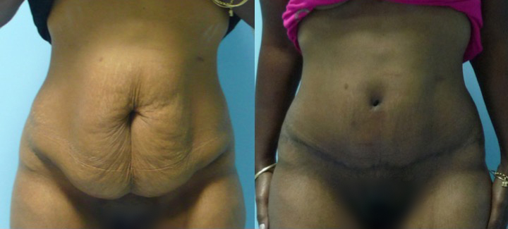 abdominoplastie-avant-apres-5 Abdominoplastie photo avant après