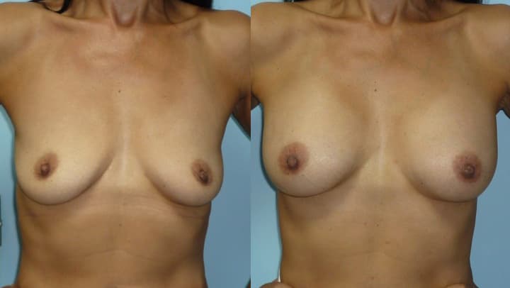 Photo avant après d'augmentation de la poitrine vue de face
