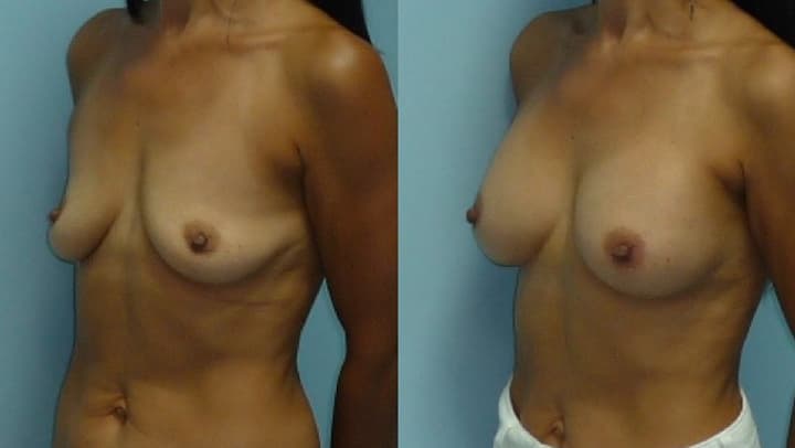 Photo avant après d'augmentation de la poitrine vue de profil