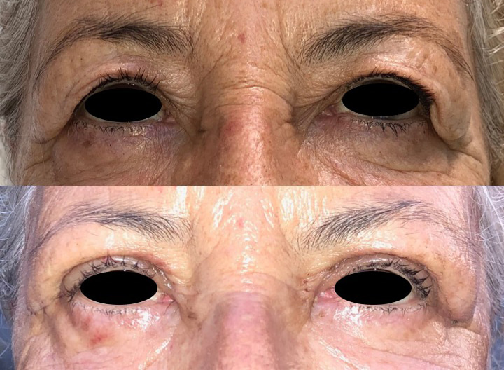 Blépharoplastie avant après