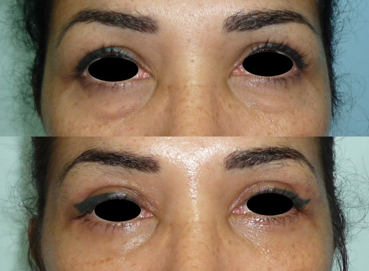 Photos avant après de blépharoplastie