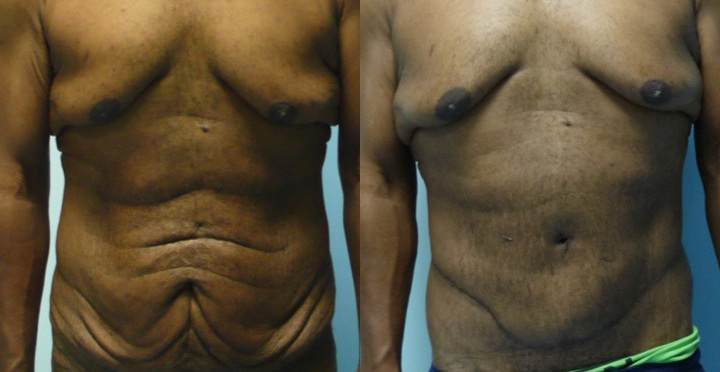 Bodylift avant après vue de face