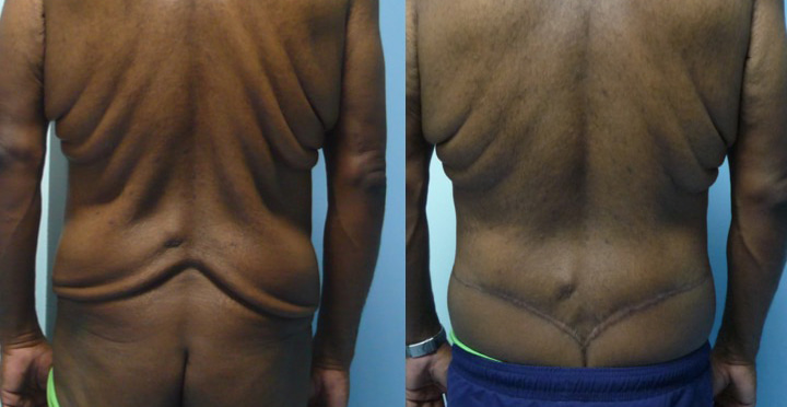 Bodylift avant après de dos