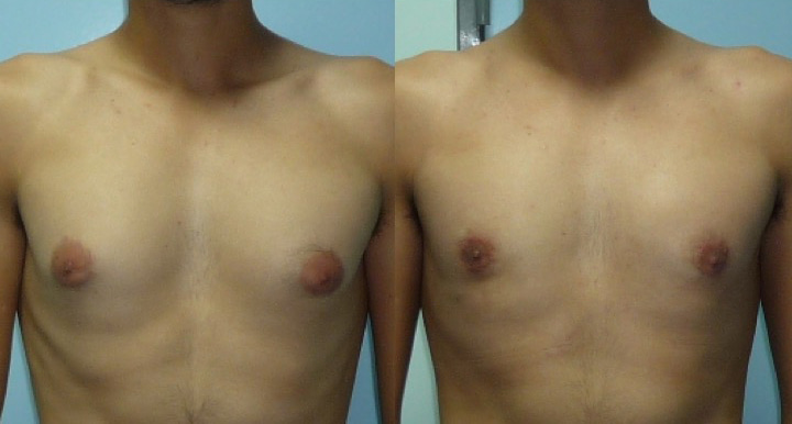 gynecomastie-avant-apres-2 Photo avant après de gynécomastie