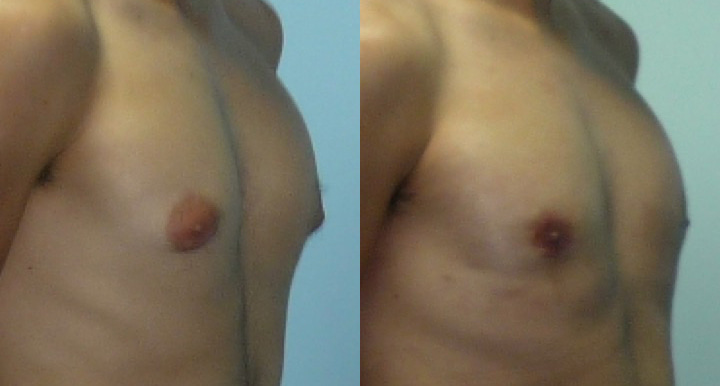 gynecomastie-avant-apres-3 Gynécomastie avant après