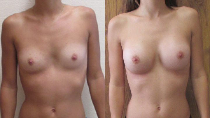 Implant mammaire photos avant après