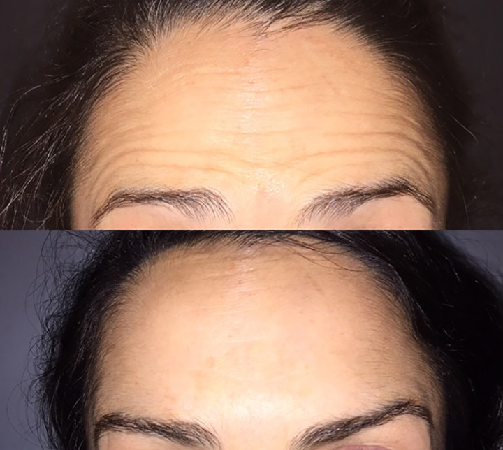 Injections botox avant après face