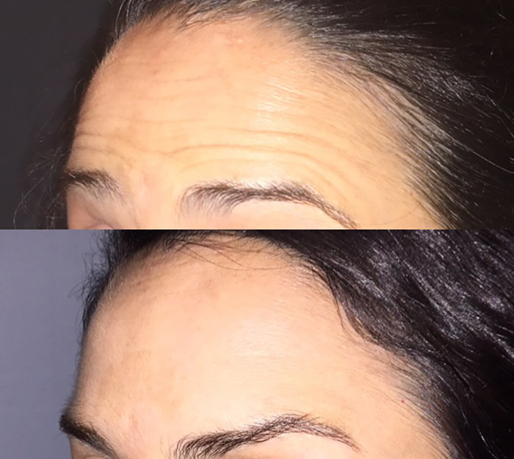 Injections botox avant après profil