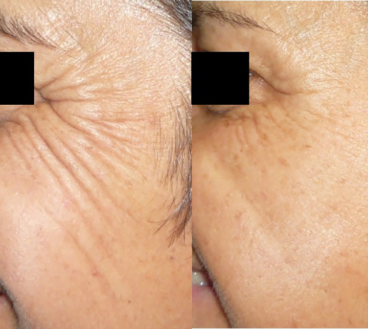 Injections toxine botulique avant après profil