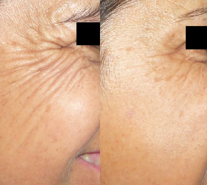 Injections toxine botulique avant après