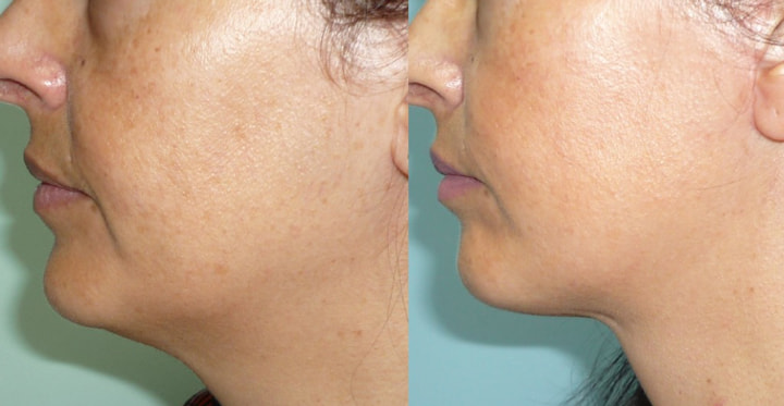Lifting du visage photo avant après