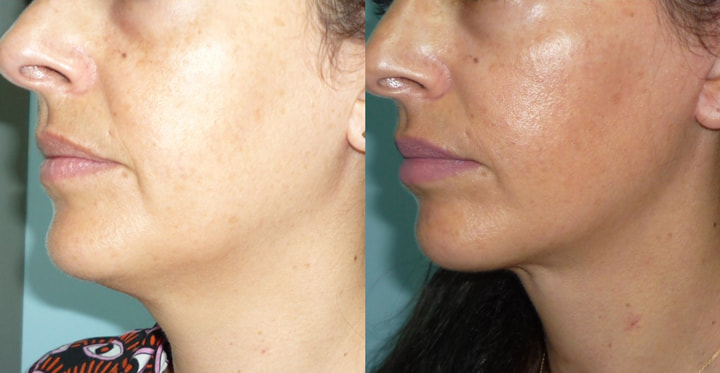 Lifting cervico facial photo avant après