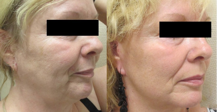 Lifting cervico facial avant après