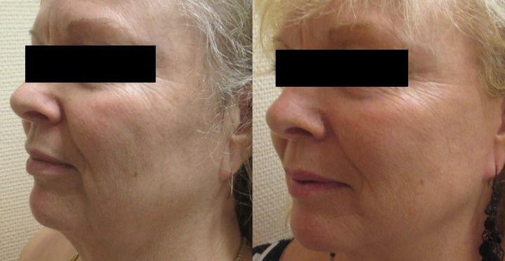 Lifting facial avant après