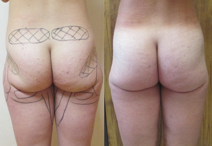 Lipostructure des fesses avant après
