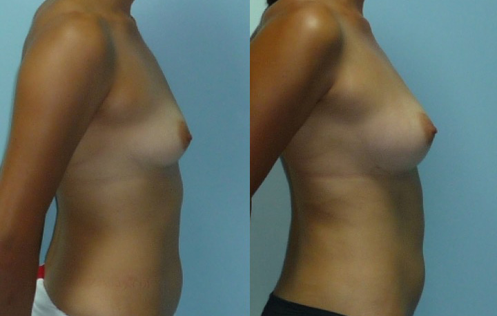 Lipofilling mammaire avant après vue de profil