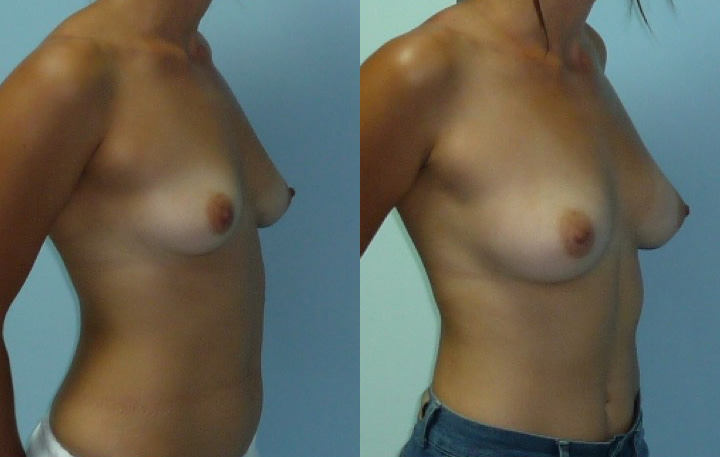Lipofilling mammaire avant après vue de 3/4