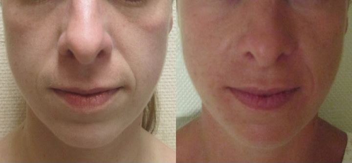Photo avant après de lipostructure du visage