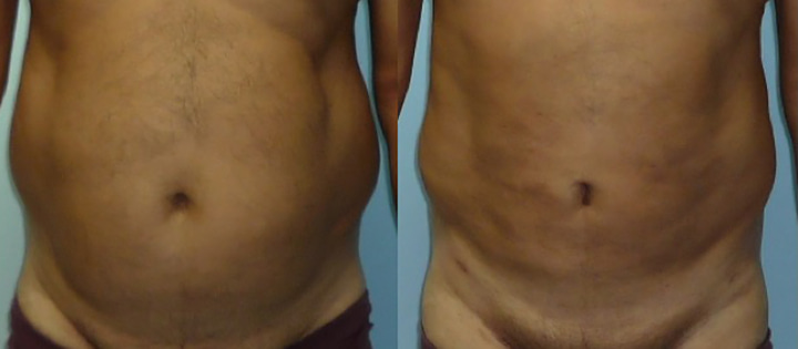 Liposuccion de l'abdomen avant après face