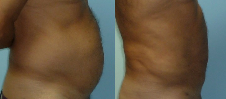 liposuccion-abdomen-avant-apres-2 Liposuccion de l'abdomen avant après profil