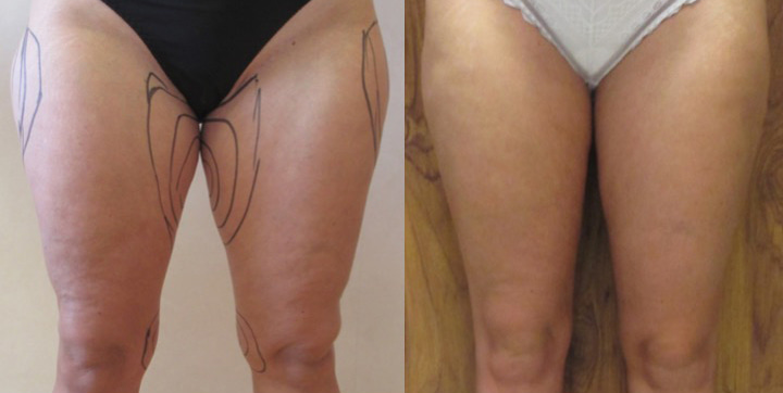 Lipoaspiration avant après