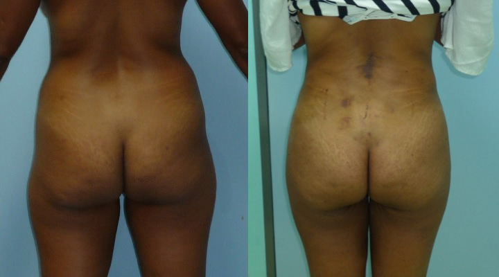 Avant après lipoaspiration des hanches