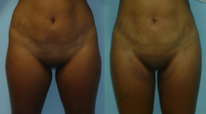 liposuccion-hanches-avant-apres-4 Photos de lipoaspiration des hanches avant après
