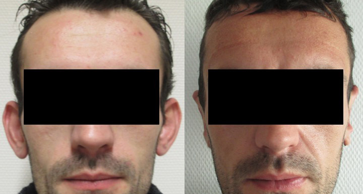 Otoplastie avant après vue de face
