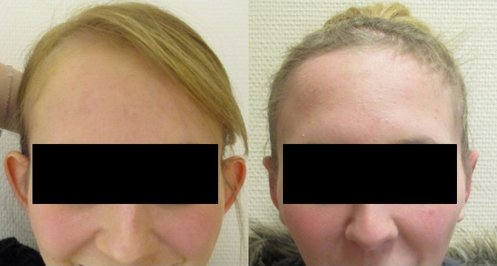 Photo avant après de chirurgie des oreilles décolées