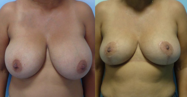 Photo avant après de réduction des seins