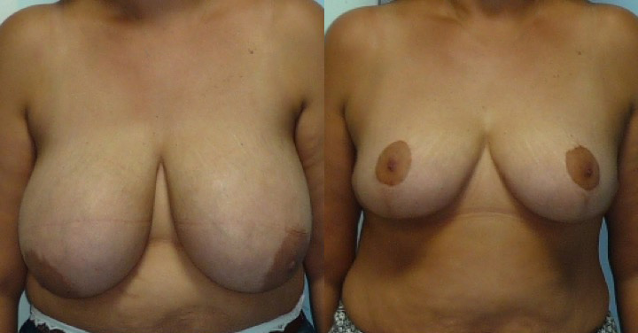 Réduction des seins photos avant après