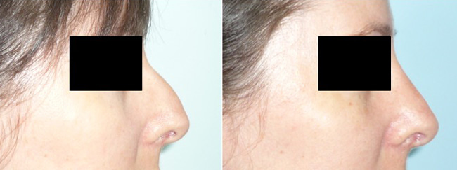 Rhinoplastie avant après