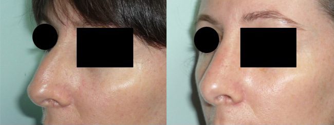 rhinoplastie-avant-apres-2 Chirurgie du nez avant après
