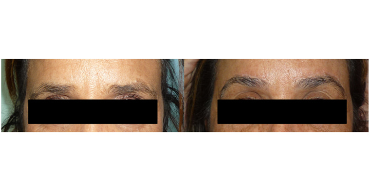 Photo avant après d'un lifting des sourcils