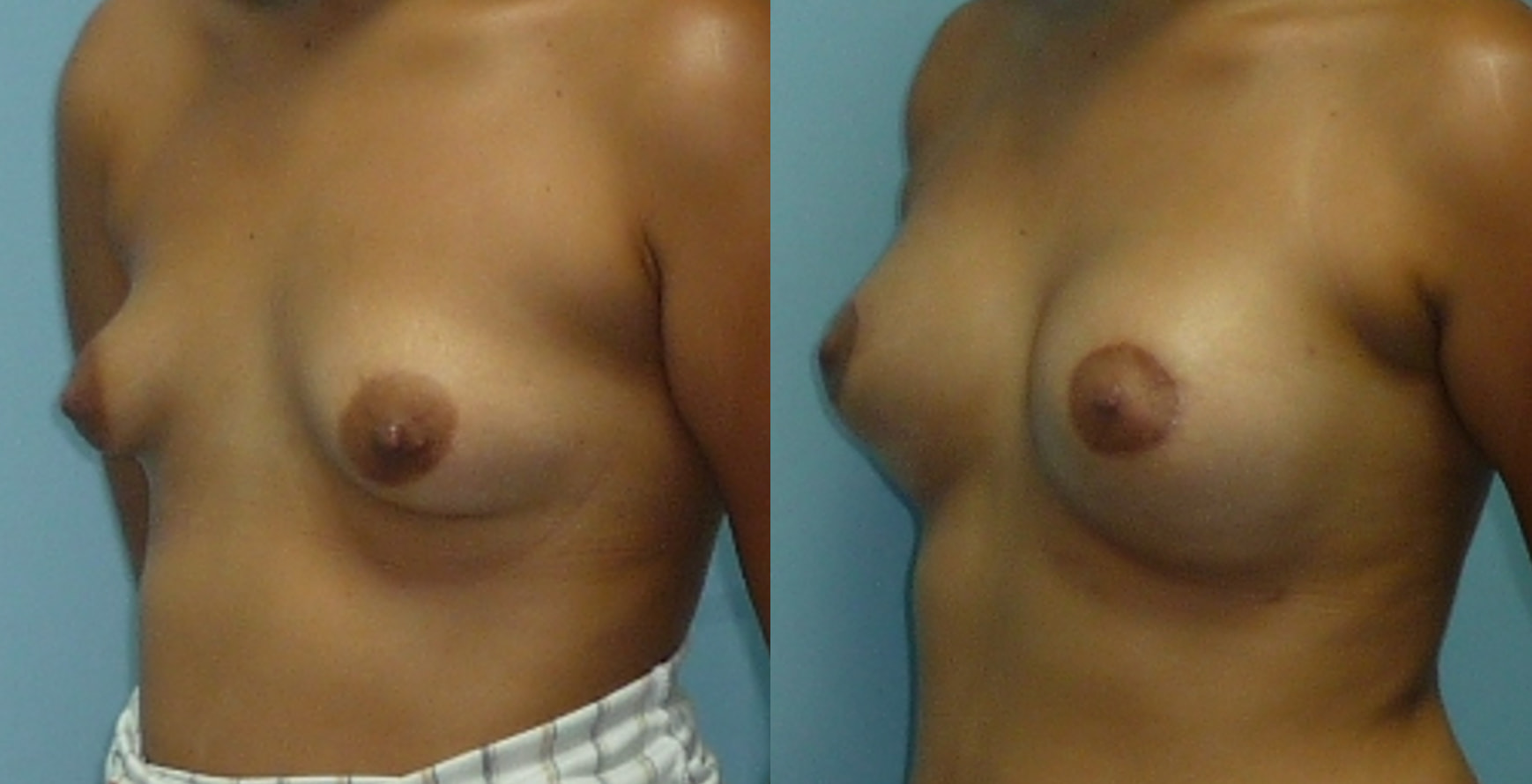 Chirurgie des seins tubéreux photo avant après