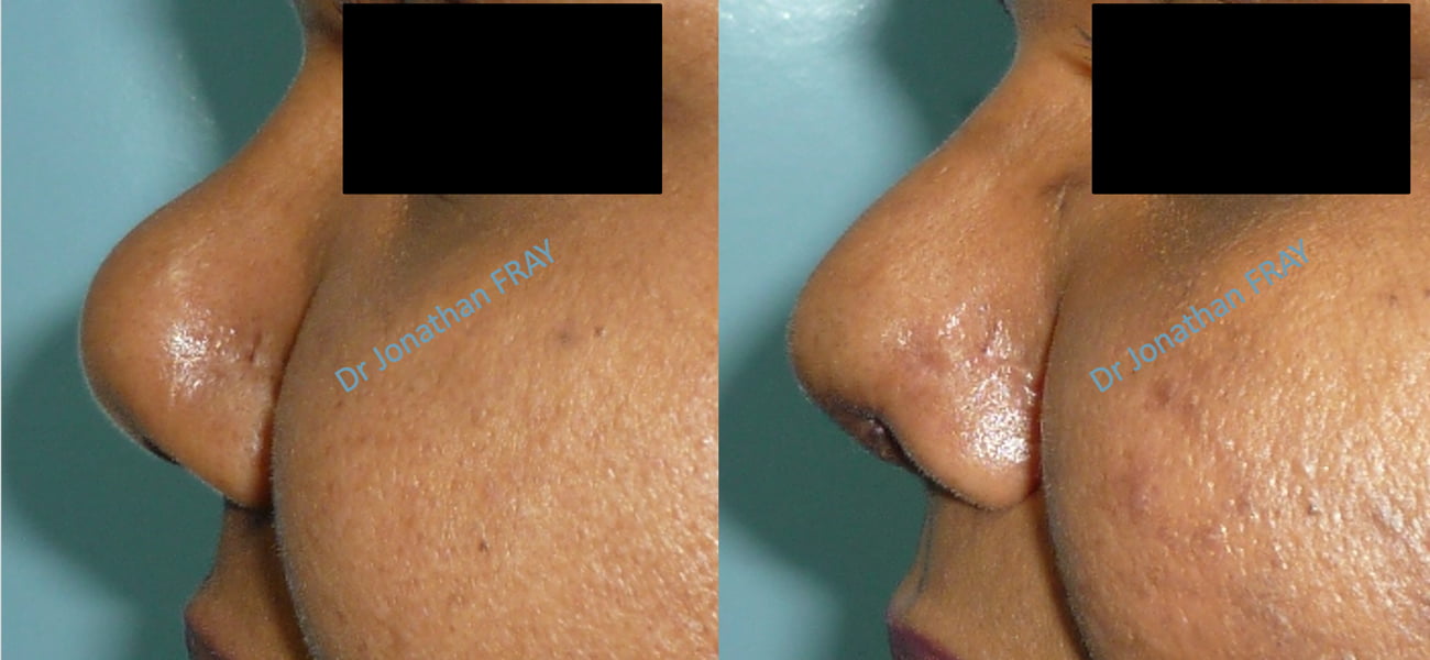chirurgie-nez-avant-apres-1 Résultats avant après d'une rhinoplastie