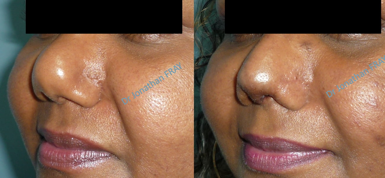 chirurgie-nez-avant-apres-2 Comparaison avant après d'une rhinoplastie