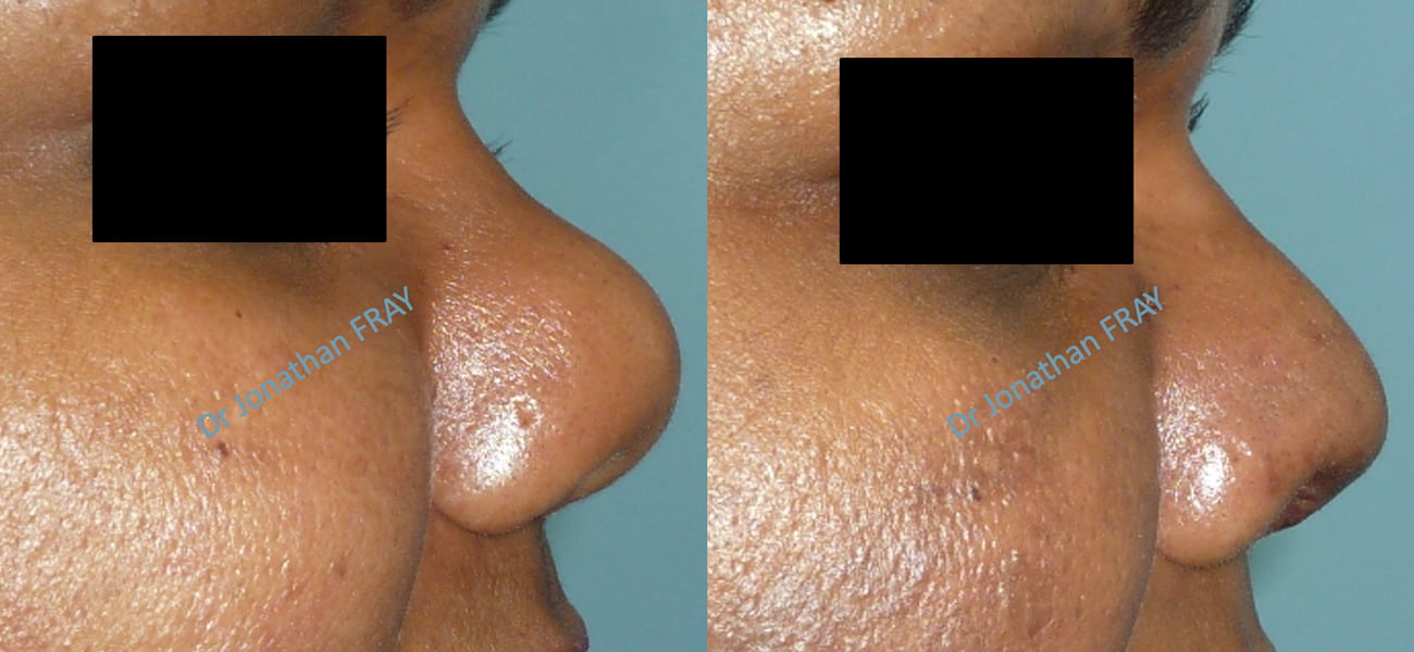 chirurgie-nez-avant-apres-3 Chirurgie esthétique du nez avant après