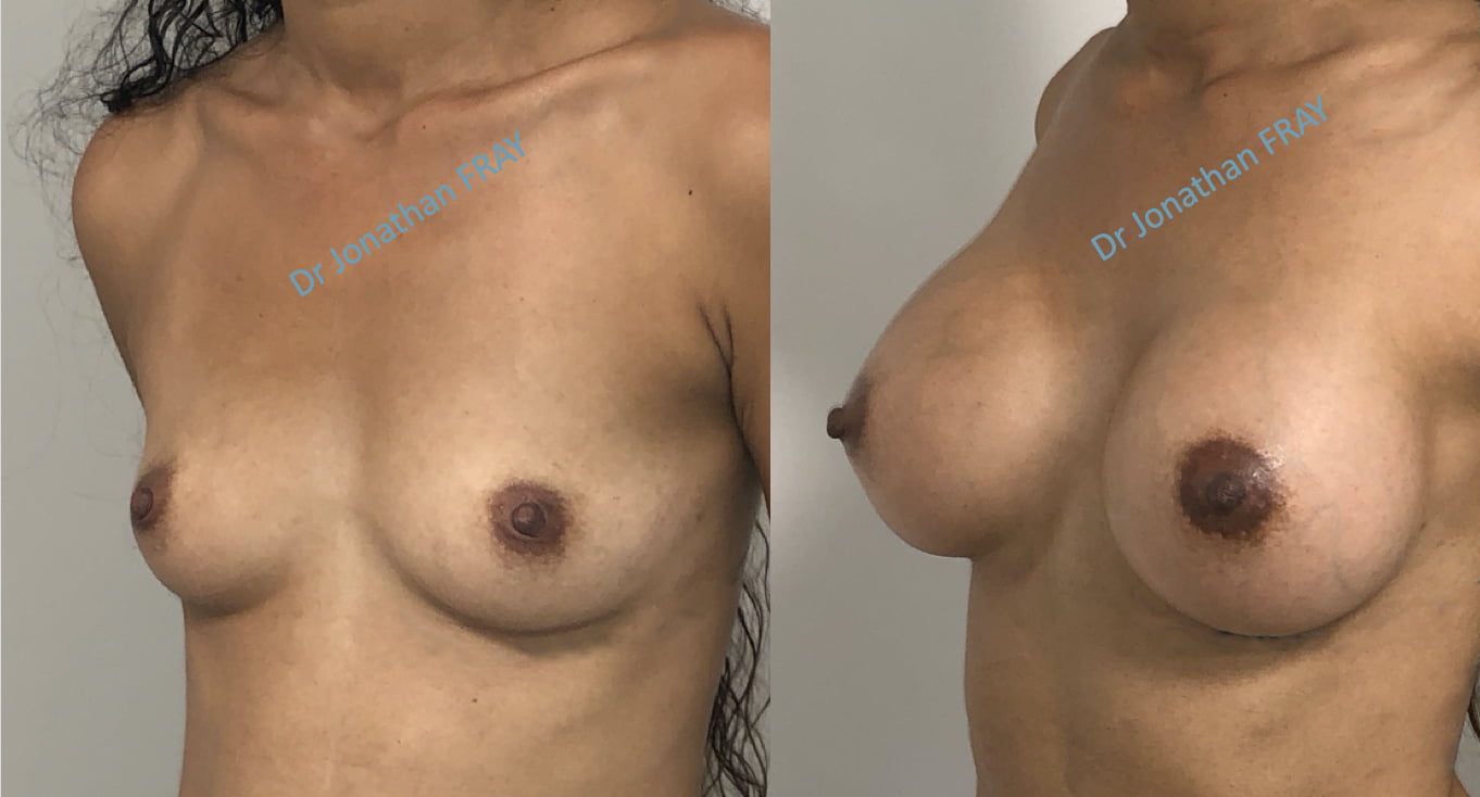 Pose de prothèse de seins avant après