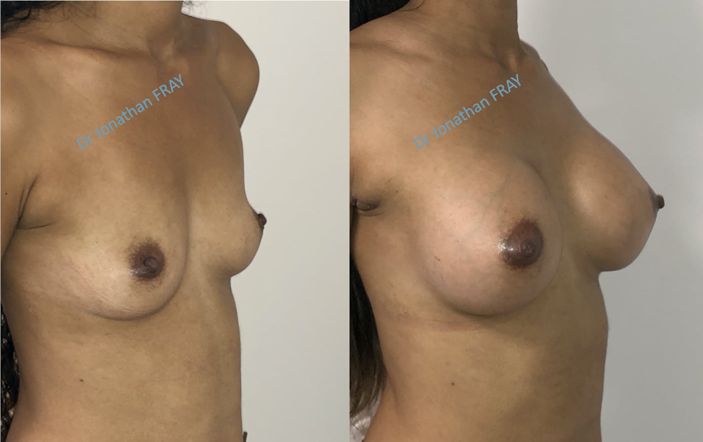 Avant après d'une pose d'implants mammaires