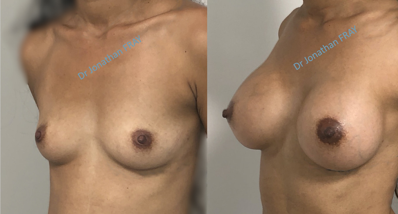 Avant après d'une pose d'implants mammaires